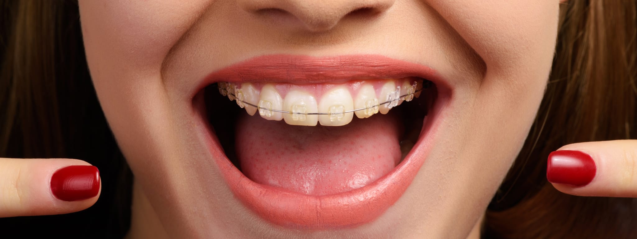 senhora a sorrir e a mostrar o seu aparelho dentário