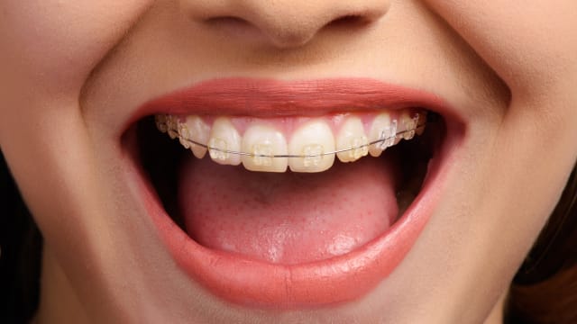 senhora a sorrir com aparelho dentário transparente nos dentes